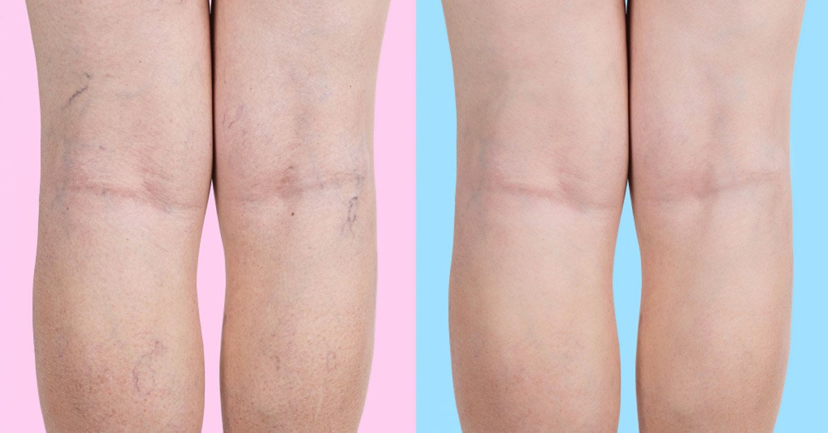 MEDIAS ANTI - VARICES CON CIERRE