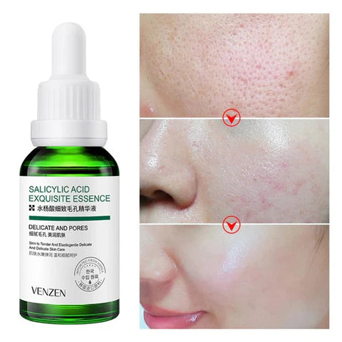 Kit/Combo x 5 Ácido Salicílico Anti-Acné | Tratamiento Facial Para El Acné - BIOAQUA