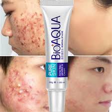 CREMA ANTI ACNE - BIOAQUA